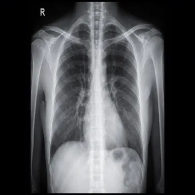 Chest X-Ray